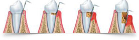 Periodoncia